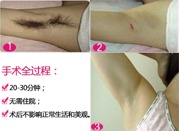 治疗腋臭改良小切口汗腺清除术 手术 过程.jpg